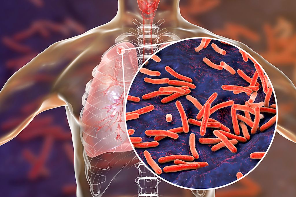 Tuberculosis: Early diagnosis, treatment key
